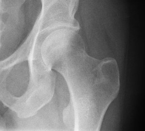 hip-x-ray